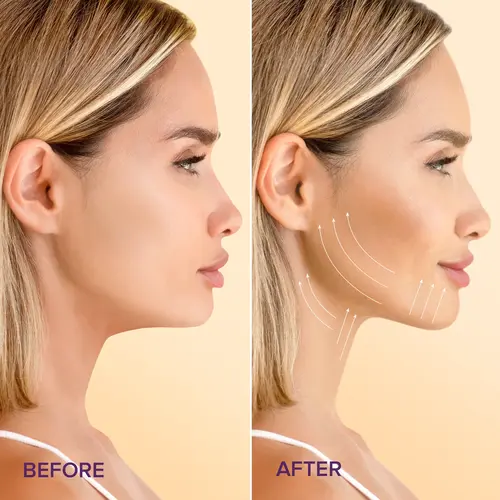 Before and after using Maree V Lifting Face Mask